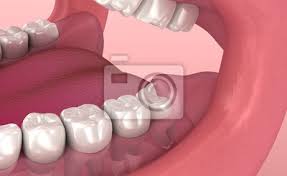 Ein nerv im kiefer umschlossen ist; Weisheitszahnproblem Medizinisch Genaue Zahn 3d Animation Leinwandbilder Bilder Wachsen Problem Probleme Myloview De