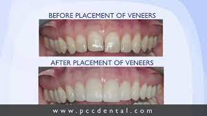 For instance, how you care for them plays an important role in their longevity. Ask Gordon Do Ceramic Veneers Last As Long As Crowns Youtube