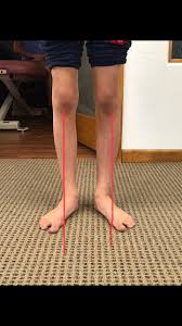 Image result for Femoral Retroversion