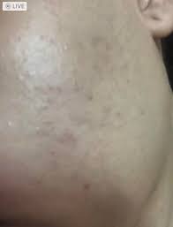 My skin is not continuing to be red or blister or flake. Hyperpigmentation Spots After Laser Hair Removal On The Face It Really Red Inflamed After The Session Then It Became Brown Dermatologyquestions