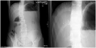 Superior Mesenteric Artery Syndrome A Rare But Life Threatening Disease Sciencedirect