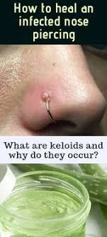 10 Natural Home Remedies For Curing Infected Keloid On Nose Piercing Teshil Com Nose Piercing Care Nose Piercing Bump Piercing Bump