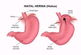 Image result for stomach hernia symptoms