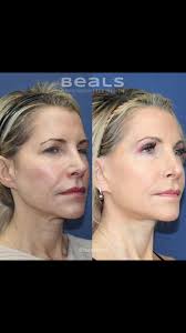 A #minifacelift, #bilateralupperblepharoplasty, and #endoscopicbrowlift was  the perfect combination to refresh our already gorgeous, 54-yr old patient.  Combining the brow lift and upper blepharoplasty ...