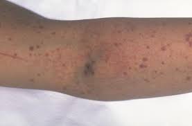 The spots are caused by bleeding underneath the skin secondary to platelet disorders, vascular disorders, coagulation disorders, or other causes. Immune Thrombocytopenia Hematology Oncology Associates Of Cny