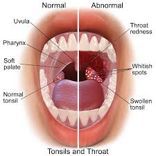 Strep Throat Symptoms To Watch Out For Physician 360 Online Consults And Treatment