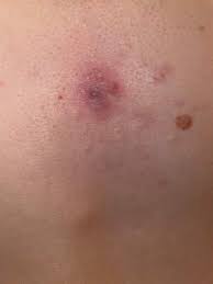 Pickel Oder So Zwischen Der Brust Gesundheit Und Medizin Haut