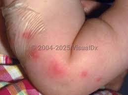 Image result for Papular urticaria