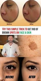 Many People Have Brown Spots Or Age Spots On Their Face And Skin And Even Though They Are Not Very Scary Brown Spots On Face Spots On Face Brown Spots On