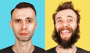 Hair transplanted from another part of the body, into the facial hair area. Beard Transplant Should You Do It What You Need To Know