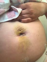 Endo belly is the severe bloating endometriosis causes. After My Endometriosis Excision Surgery I Couldn T Believe How Big My Belly Got They Went In With The Camera Through My Belly Button Medizzy