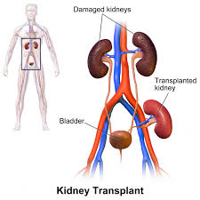 An Individual Requires Minimum One Kidney To Perform All The Functions Properly And To Survive So If In Any Ca Kidney Transplant Renal Transplant Kidney Donor