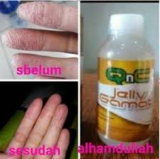 Obat Salep Untuk Telapak Jari Tangan Telapak Tangan Pecah Pecah Di Apotik Tangan Telapak Tangan Kimia