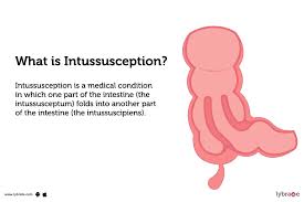Image result for Intussusception