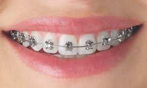 Image result for dental braces