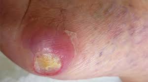 Symptoms of diabetes on your feet. Pictures Of Diabetic Neuropathy