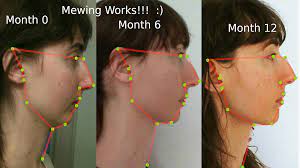 Maybe you would like to learn more about one of these? What Is Mewing And Does It Work