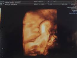 Was für den geplanten kaiserschnitt spricht. Meine Art Zu Entbinden Ein Geplanter Wunschkaiserschnitt Mamahoch2