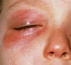 Dry Skin Around Eyes Causes Wrinkles Eczema Vaseline Red Flaky Itchy How To Get Rid Healthr Dry Skin Around Eyes Dry Skin Under Eyes Red Irritated Skin