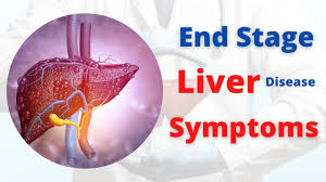 Symptoms Of End Stage Liver Disease Liver Cirrhosis Youtube