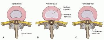 Intervertebral Disk Disease And Radiculopathy Neupsy Key