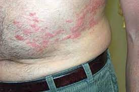 Maybe you would like to learn more about one of these? Ø£Ø·Ø¨Ø§Ø¡ Ø§Ù„Ø£Ù…Ø±Ø§Ø¶ Ø§Ù„Ø¬Ù„Ø¯ÙŠØ© ÙŠØ¤ÙƒØ¯ÙˆÙ† Ø§Ø±ØªÙØ§Ø¹ Ù†Ø³Ø¨Ø© Ø§Ù„Ø¥ØµØ§Ø¨Ø© Ø¨Ø§Ù„Ø­Ø²Ø§Ù… Ø§Ù„Ù†Ø§Ø±ÙŠ Ø¹Ø¨Ø± Ø§Ù„Ø¥Ù…Ø§Ø±Ø§Øª Ø§Ù„Ø¨ÙŠØ§Ù†