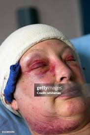 195 Brain Swelling Stock Photos, High-Res Pictures, and Images