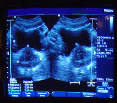 Your doctor will want to discuss treatment options as well as the prognosis for bladder cancer. Ultrasound Image Of An Enlarged Prostate Gland
