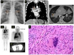 It often occurs in the lungs and lymph nodes, but it can occur in almost any organ. Sarcoidosis Annals Of Allergy Asthma Immunology