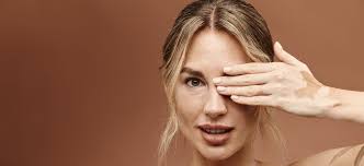 Image result for Vitiligo