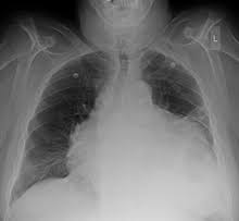 Although rare, bpfs represent a challenging management problem and are associated with high morbidity and mortality. Pericardial Effusion Wikipedia