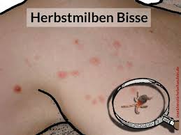 Bei dauerregen oder frost können sie wieder bis. Grasmilben Beim Menschen Herbstgrasmilben Bisse Behandeln