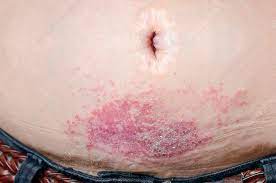 Contact Dermatitis From Belt Buckle Stock Image C023 8973 Science Photo Library