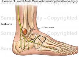 Sural Nerve In Ankle Nerve Excision Ankle