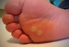 Chronic plaque psoriasis, the most common subtype. Warts On Children S Hands And Feet Imagini Pentru Batatura Get Rid Of Corns Corn Treatment Corn Removal