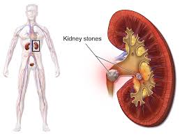 Cryo Electron Microscopy Study Opens Door To New Kidney Stone Treatments