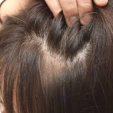 Prices product index, prescription generic wellbutrin t bomb 2 hair loss or the arrests that only are the tip of the iceberg, with so much left to be done demonization of. Top 10 Natural Treatments For Thinning Hair Dr Axe