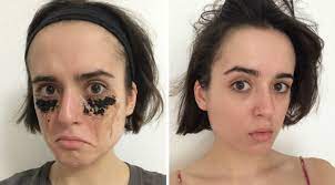 It can take anywhere between 2 weeks to 3 months to begin noticing significant reduction in the appearance of cellulite, but trust me, sooner or later, you will notice a favorable change with time. I Used A Coffee Undereye Mask For One Week And The Results Weren T What I Expected Hellogiggles