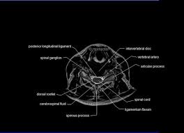 Mri Spine Anatomy Free Mri Axial Cervical Spine Anatomy Anatomy Mri Vertebral Artery