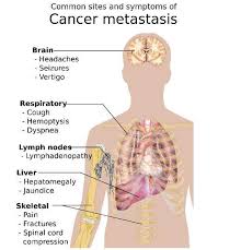 The term cancer covers a group of diseases in which abnormal cells divide without cause and control, thereby invading and harming other tissues. Zometa For Preventing Bone Cancer Complications Clinical Trials Arena