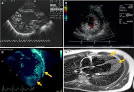 Image result for Left Ventricular Noncompaction