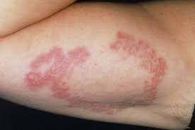 Rash in bend of arms. Granuloma Annulare Nhs