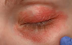 Image result for demodex rosacea
