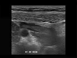 Ovarian Vein Thrombosis Radiology Case Radiopaedia Org