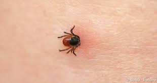 Borreliose Symptome So Erkennen Sie Die Krankheit Netdoktor