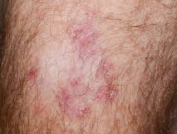 Understanding liver cancer is important if you want to develop an effective treatment plan and live a long and healthy life. Basal Cell Carcinoma Affecting Arms And Legs Images Dermnet Nz