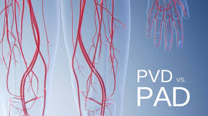 are pad and pvd the same disease