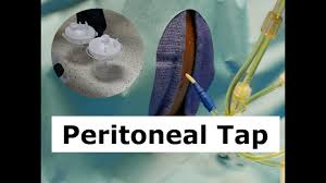There is always a balance between how much you should run and how much you should rest. How To Do A Peritoneal Tap To Drain Ascites Fluid Youtube