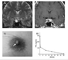 Image result for Galactorrhea