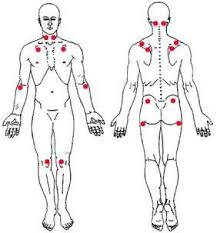 A fibromialgia é uma índrome crônica de caua deconhecida que provoca dor por todo o corpo e outro intoma, como canaço frequente e ditúrbio do ono, por exemplo. A Importancia Da Fisioterapia No Tratamento Da Fibromialgia